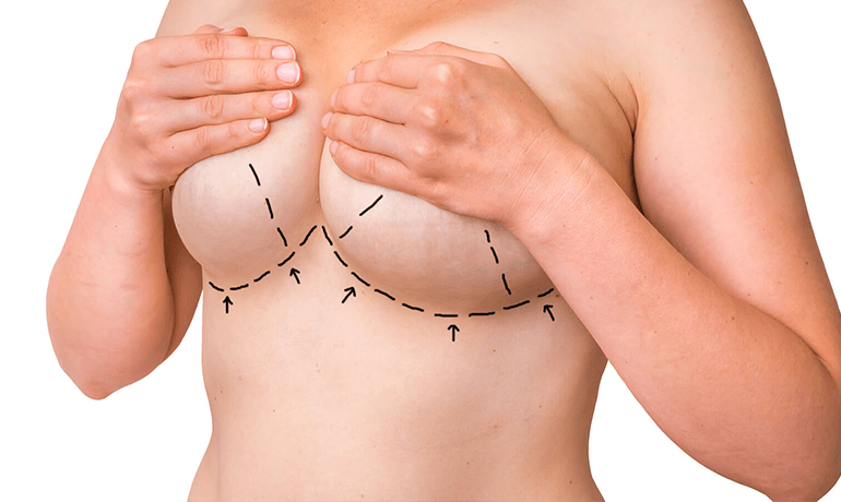 Meme büyütme ameliyatı sonrasında ameliyat olduğum anlaşılır mı?