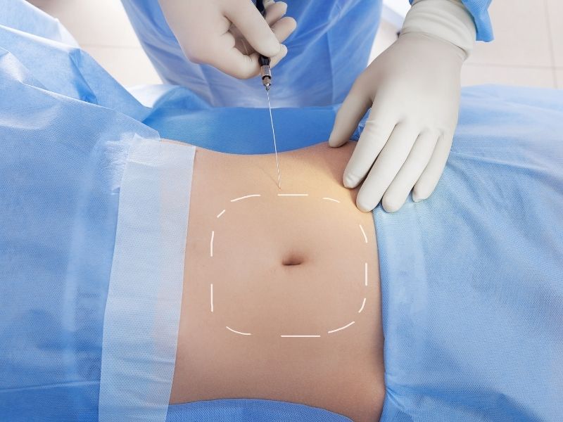 Lazer Lipoliz İçin En Uygun Mevsim Nedir?