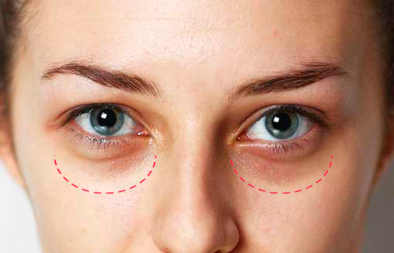 Göz Altı Morluklarının Tedavisi